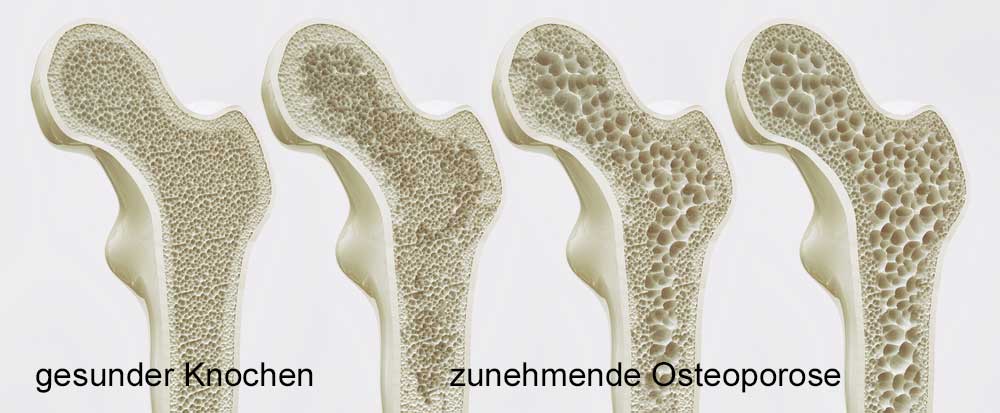 Stadien der Osteoporose